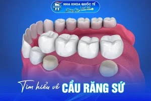Cầu răng sứ là gì?