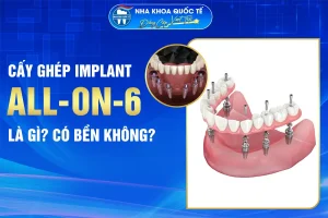 cấy ghép all on 6