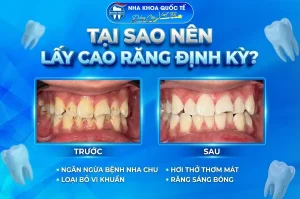 tại sao nên lấy cao răng định kỳ