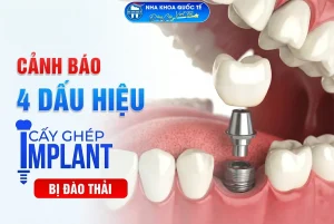 4 dấu hiệu implant đào thải