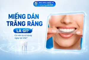 Miếng dán trắng răng là gì