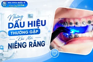 những dấu hiệu thường gặp khi mới niềng