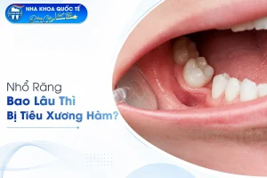 nhổ răng bao lâu thì bị tiêu xương hàm