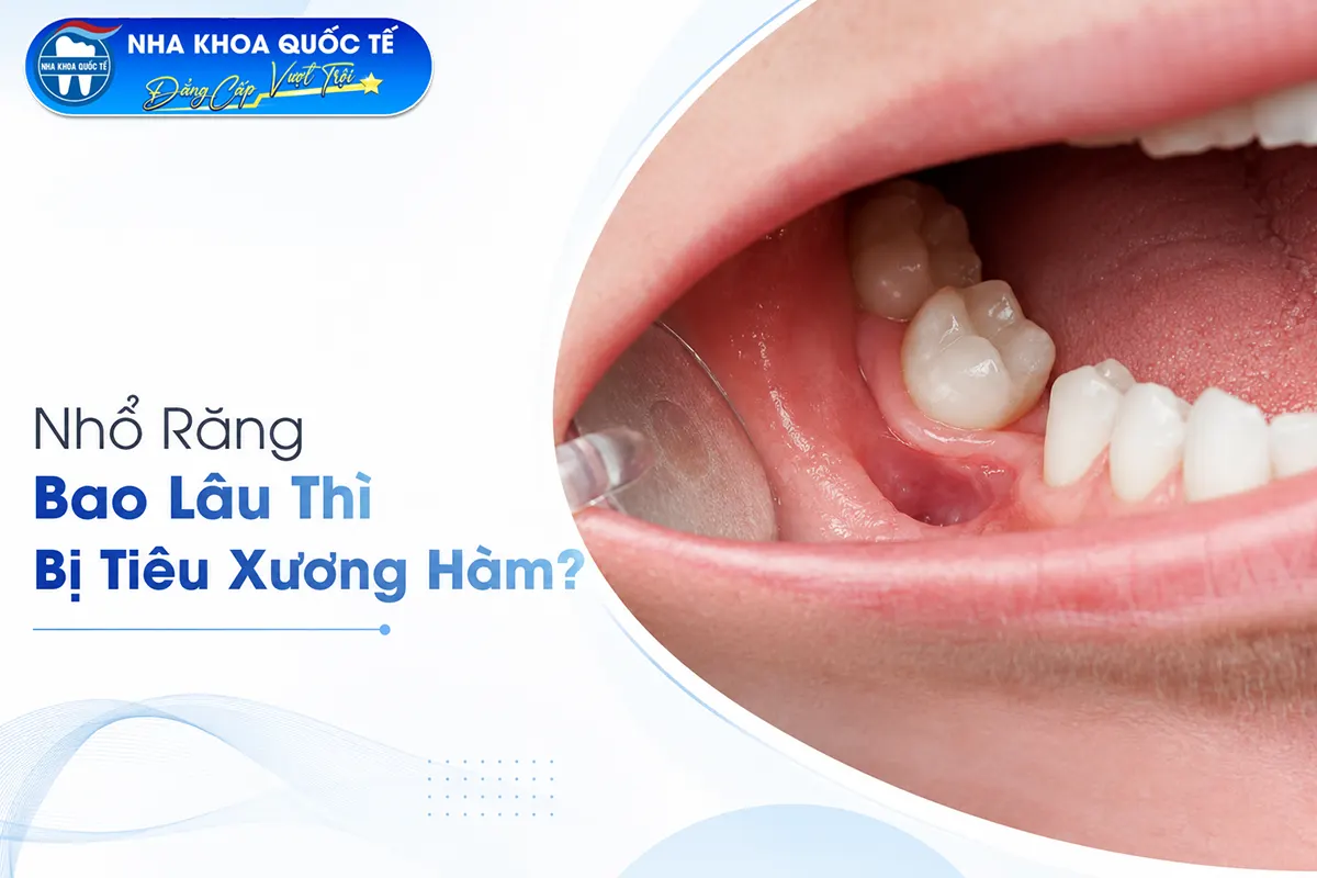 nhổ răng bao lâu thì bị tiêu xương hàm