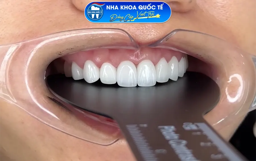 răng sứ thẩm mỹ đẹp