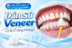 dán sứ có bị ố vàng ko